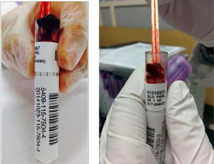 EDTA tube microclot 예