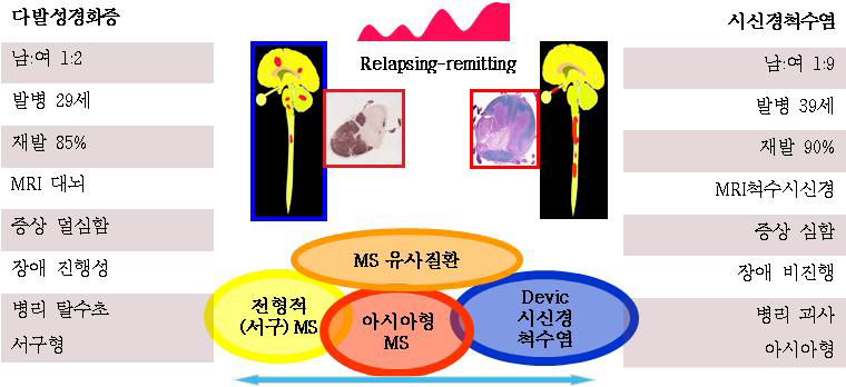 다발성경화증과 시신경척수염의 임상적 차이