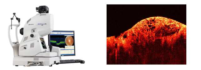 Optical Coherence Tomograph (OCT).