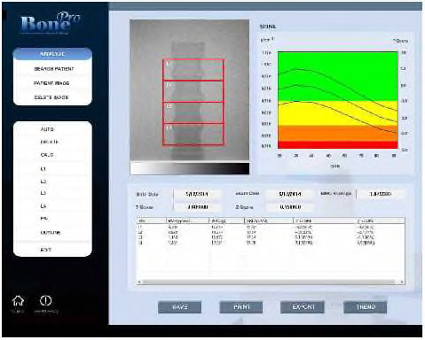 골밀도측정기 실제 촬영 후 Analysis 화면