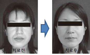 턱관절 이상자의 치료 전후 효과의 정량적 검증