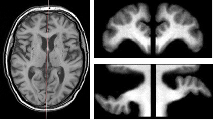 MRI 뇌영상의 좌우 대칭 분석 및 수치화