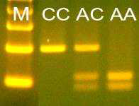 FMO-1 유전자 분석 결과