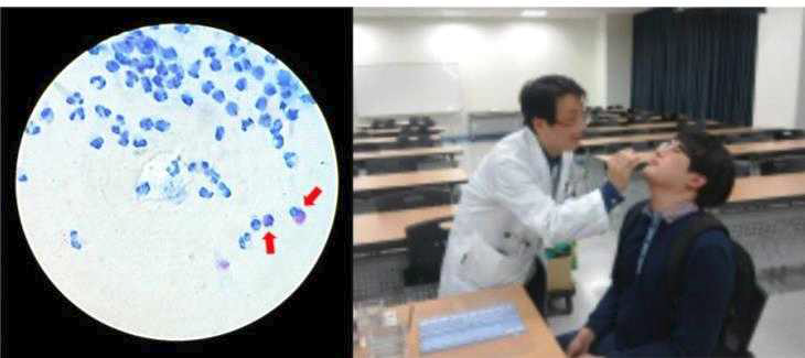 The sample image of Wright-Giemsa staining for nasal smear cytology (left; Red arrows indicate eosinophils.), the procedure and process for sampling nasal smear specimens (right).