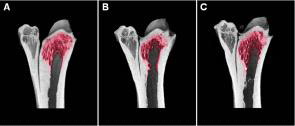 3D reconstruction images of tibial distal part, using Micro-CT analysis