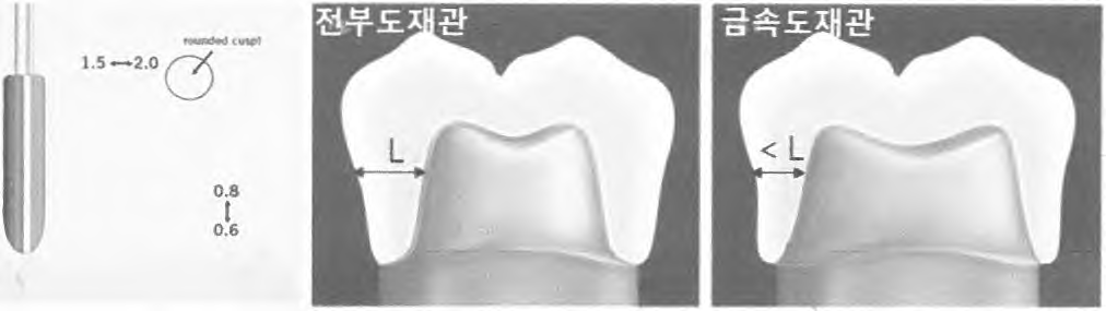 전부도재관과 금속도재관의 자연치 제거량 비교