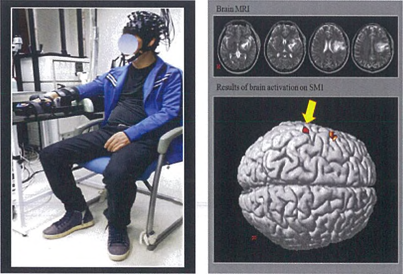 실제 환자에 적용하여 입차 감각.운동 영역의 뇌의 활성 확인