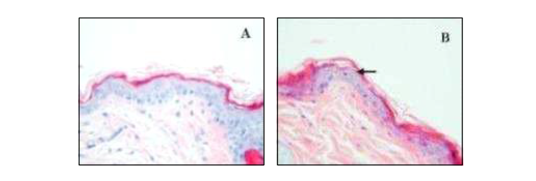 일광화상 전(A: 정상 세포군)과 후(B: UV-B 조사군)의 비교