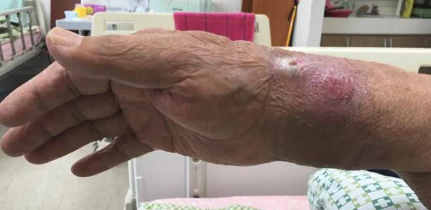 Swelling & redness of Rt. wrist(thumb side)