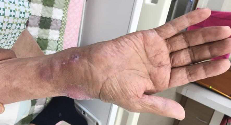 Swelling & redness of Rt. wrist(palm side)