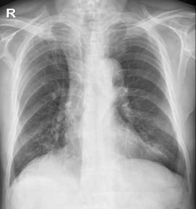 Chest radiograph, Fibroatelectatic change with linear opacity in RUL. Bronchiectasis with mucus plugging in RML and LLL.