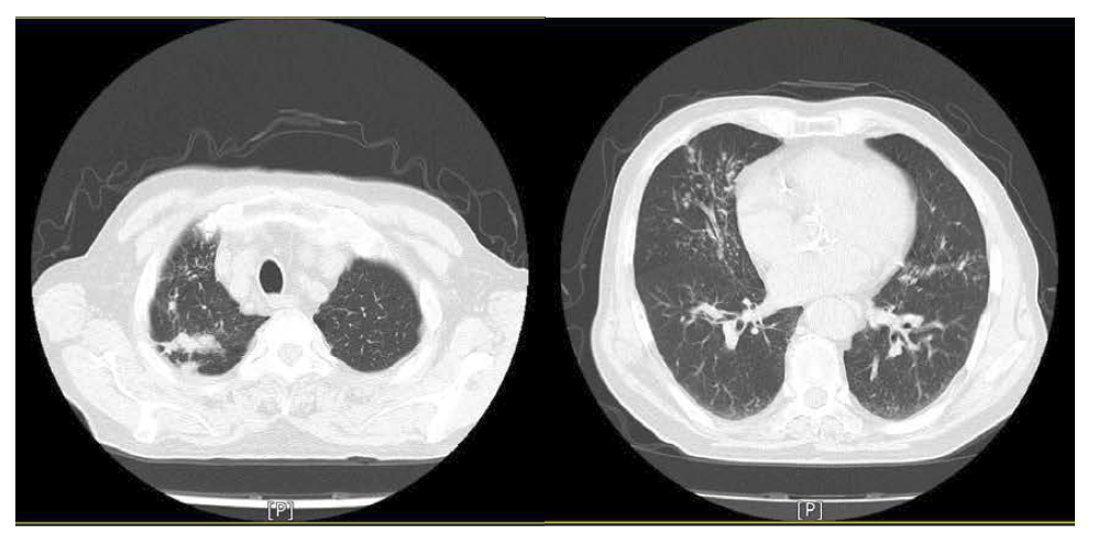 Chest CT, Several clustered nodules with tree in bud in RML and BULs. Fibroatelectatic change with fibrotic scars and emphysema in RUL.
