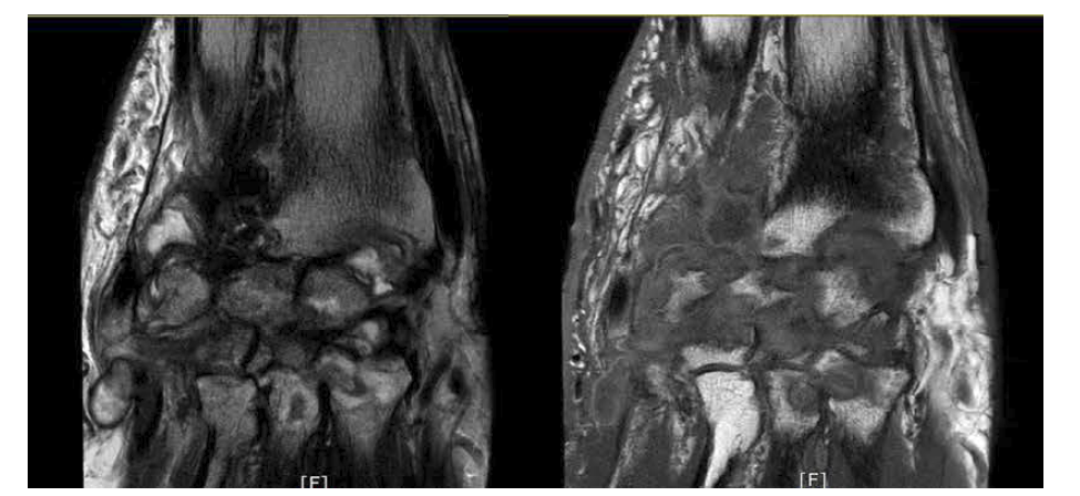 Rt. forearm MRI, Severe TB arthritis and destruction of wrist joint