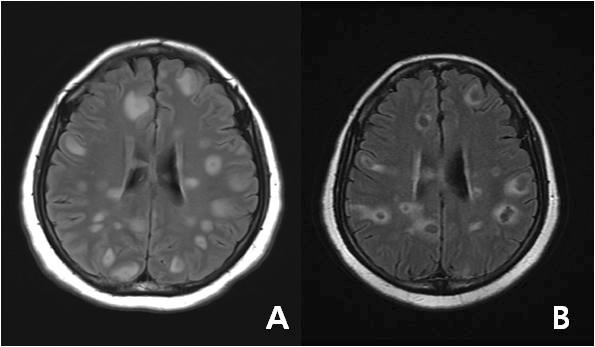진단 당시(A – T1WI, T1 Weighted Image)의 뇌병변에 비해 6개월 간격으로 추적 관 찰한 뇌 자기공명 영상 검사(B – T1WI, T2 Weighted Image)에서 뇌결핵종의 크기와 수가 다소 감소한 것으로 확인되었다.
