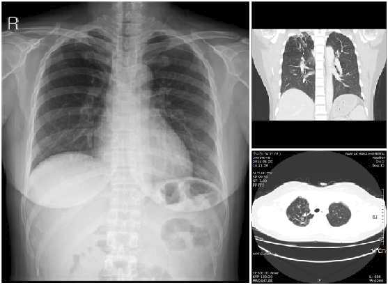 증례 환자의 폐결핵 진단 당시 X-ray 와 CT 영상. 우상엽의 불규칙한 음영 증가 소견 보이고 있으며 결핵이 의심되나 활동성 여부를 판단하기에는 적 합하지 않음.
