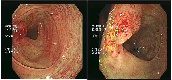 복통이 있어 시행한 증례 환자의 대장내시경 사진. 대장 내강 안쪽으로 염증성, 융기형 병변이 관찰됨.