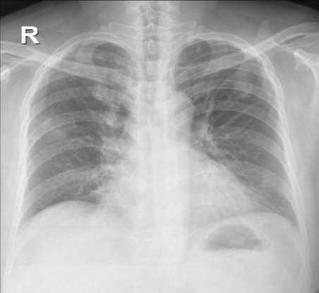 A patch consolidation on LUL(CXR).