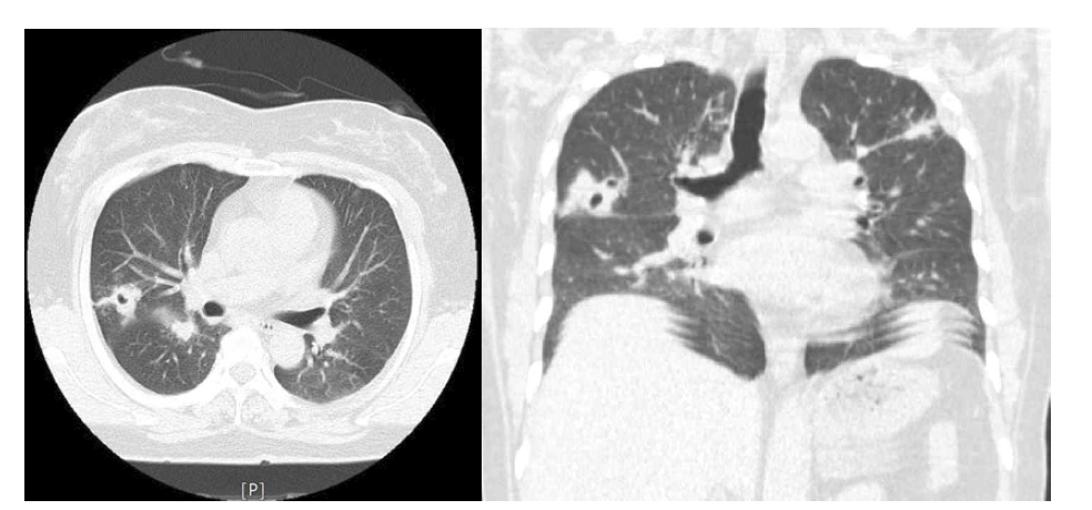 Few nodules with cavity and surrounding GGOs in BULs and RLL. Subpleural linear opacities with adjacent pleural thickening in BULs(CT)