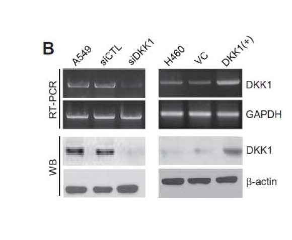 RT-PCR and Western blot analysis overexpressed and suppressed cells of DKK1 gene