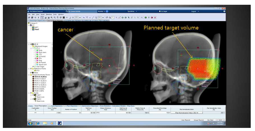 컴퓨터 치료계획 수립 및 치료선량 결정