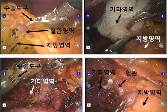 위암 수술 장면 분석 및 분할 대상