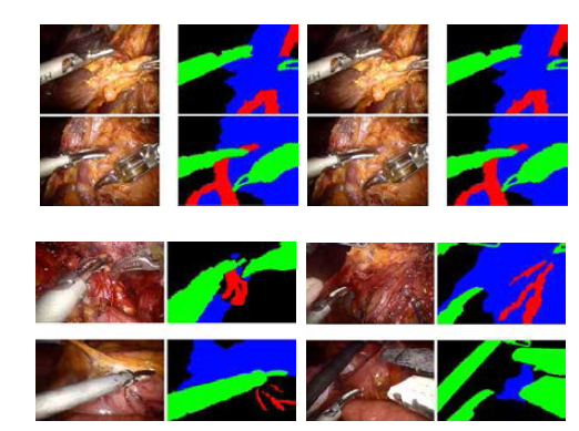 수술 영상을 분할하기 위한 학습 데이터