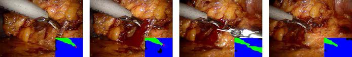위암 수술 영상 분할 결과 - 비디오 #1
