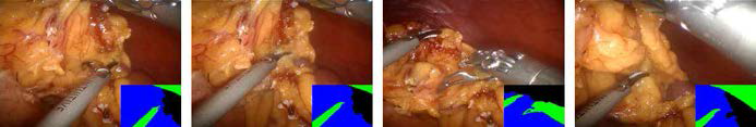 위암 수술 영상 분할 결과 - 비디오 #3