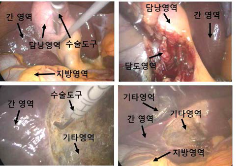 간/담낭 절제술 장면 분석 및 분할 대상