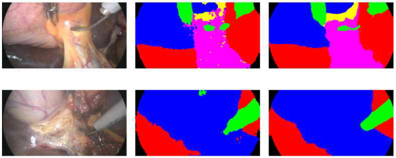 간·담낭 절제술 수술 영상 분할 결과