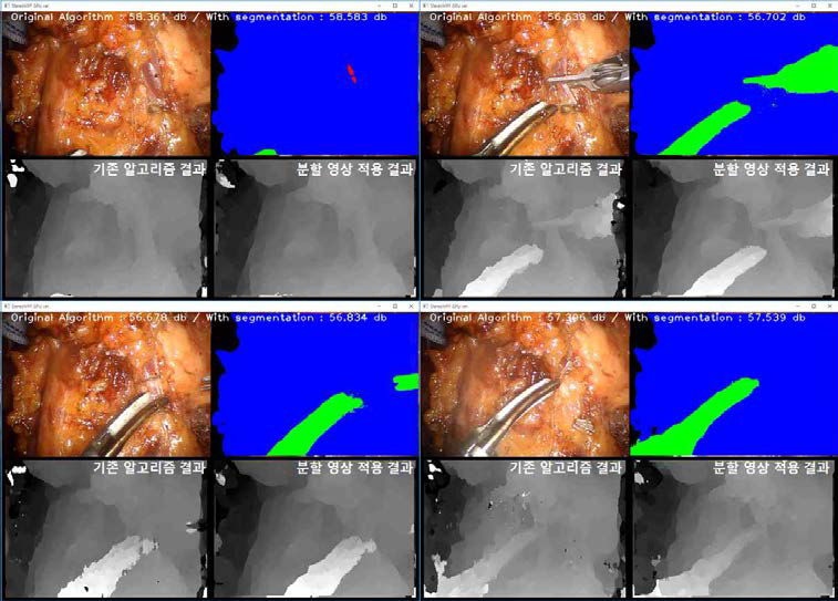 수술영상 분할 정보를 사용한 결과 비교