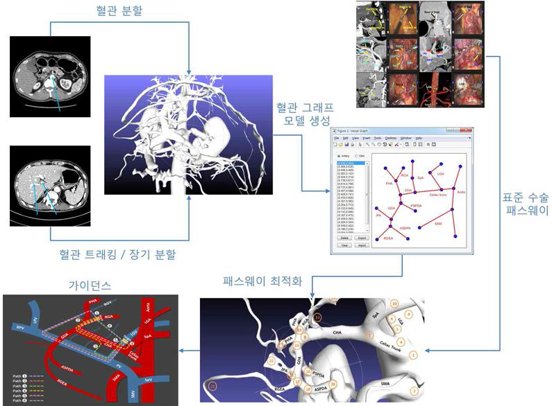 수술 패스웨이 모델링 연구 개요