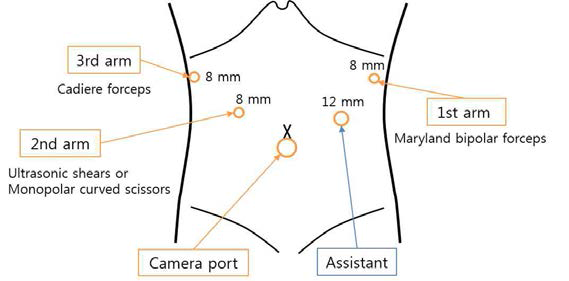 복강경 수술 시 투관침 삽입 위치