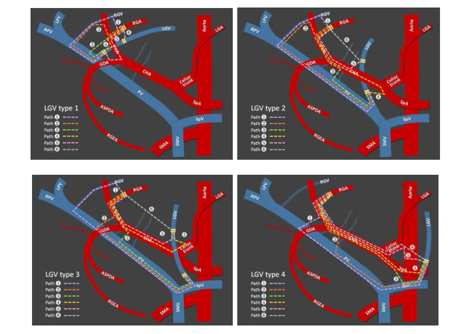 정맥 LGV의 4가지 타입에 따라 가능한 수술 패스웨이 예시