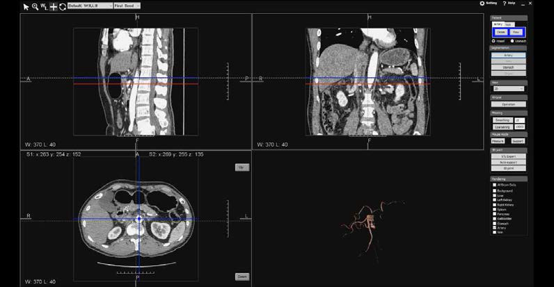수술 플래닝 해부모델 VR 뷰어: 혈관 분할을 수행한 결과 화면
