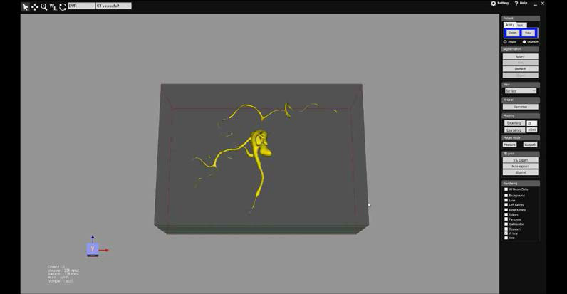 수술 플래닝 해부모델 VR 뷰어: 동맥 분할을 수행한 결과 surface 모드