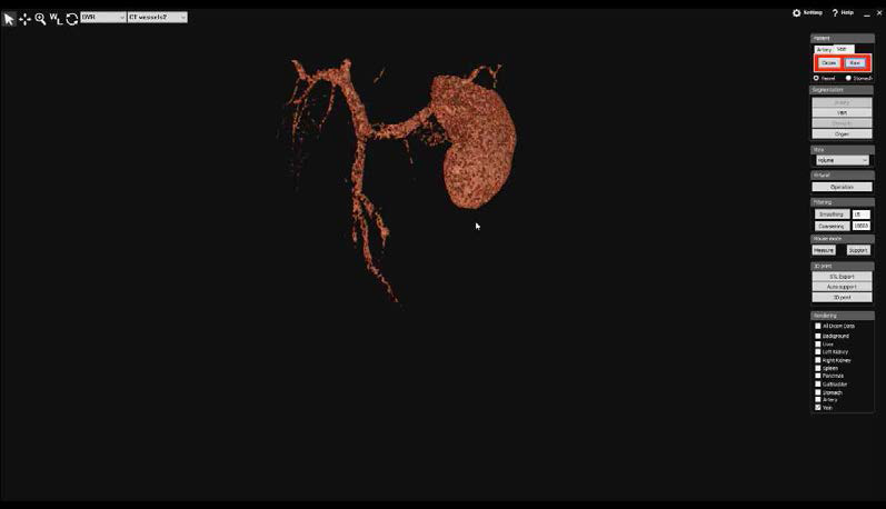수술 플래닝 해부모델 VR 뷰어: 정맥 분할을 수행한 결과 volume 모드