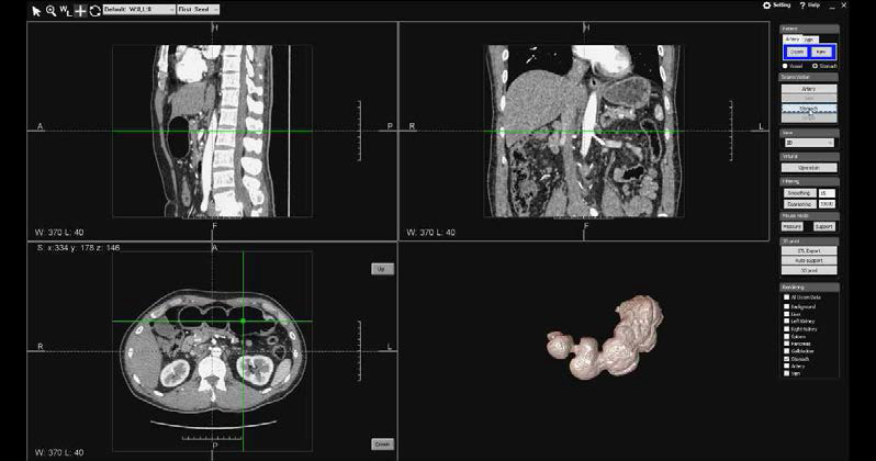 수술 플래닝 해부모델 VR 뷰어: 위장 분할 결과