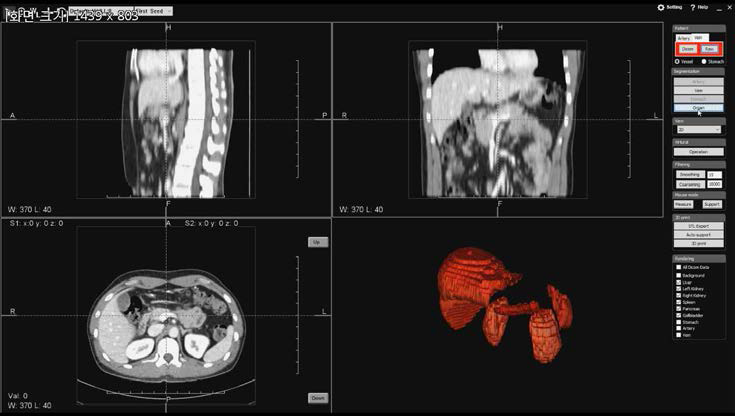 해부 모델 뷰어에서 CT 영상을 로딩하고 장기 분할 결과 삼차원 가시화