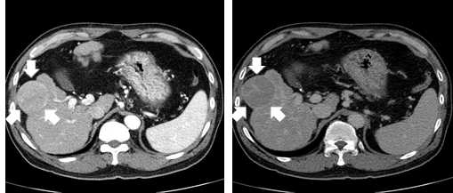 전형적 간암의 CT 소견: 동맥기(左)에서 밝게 보이고, 지연기(右)에서 어둡게 보이는 경계가 뚜렷한 종양(화살표)이 관찰됨
