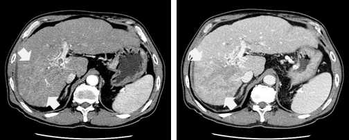비전형적 간암의 CT 소견: 특징적인 간암의 양상을 보이지 않으며 경계를 그릴 수도 없음