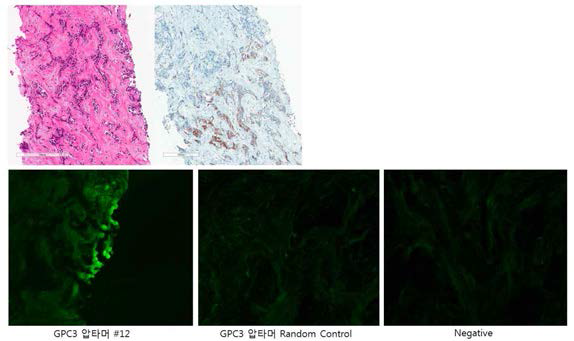 GPC3-특이 압타머의 병리 조직 샘플에서 선택적 결합성 확인