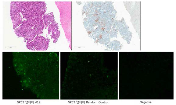 GPC3-특이 압타머의 병리 조직 샘플에서 선택적 결합성 확인