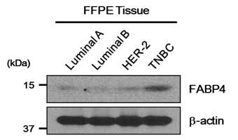 Expression of FABP4 protein in 4 subtypes of human breast cancer.