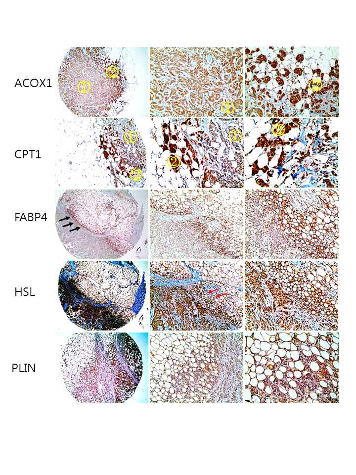 The expression of lipid metabolism-related proteins in breast cancer with adipose stroma.