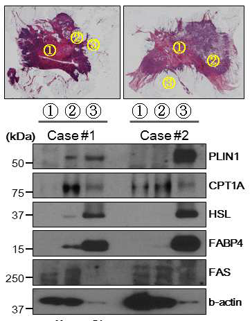 The expression of lipolysis-related protein in the different region of breast cancer tissue