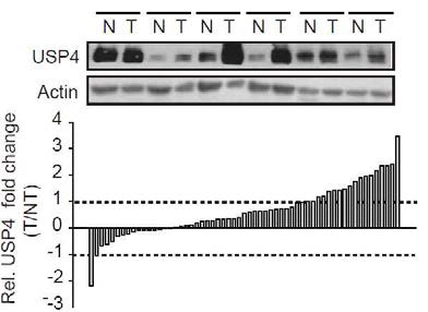 인간 간세포암 환자에서 USP4 발현 변화
