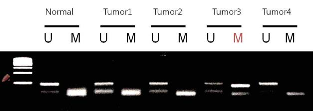 Methylation Specific PCR. Tumor numbers 1,2, and 4 habor only an unmethylated promoter, whereas tumor number 3 contains a methylated promoter.