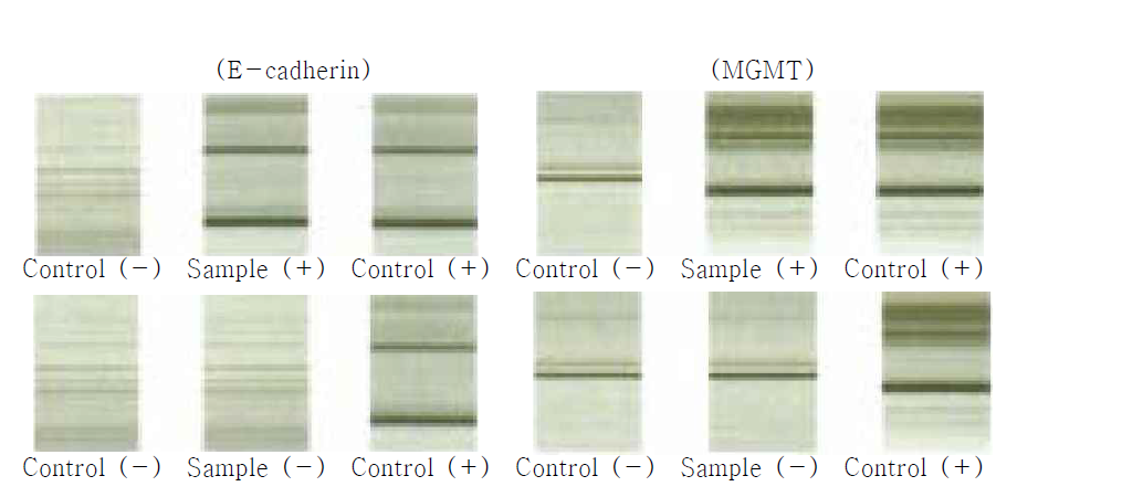 MSP analysis of E-cadherin and MGMT in plasma samples of gastric carcinoma patients