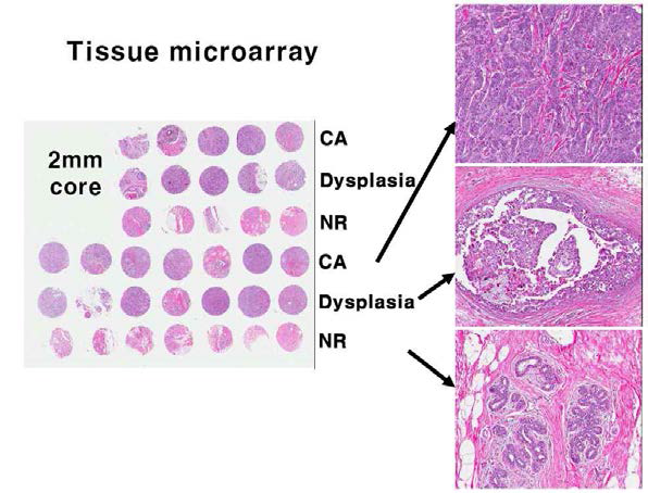 Tissue microarray of colon cancer